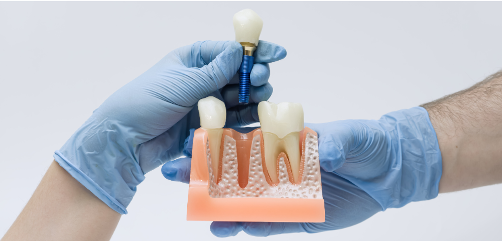 (P) Îngrijirea după implant dentar: reguli simple care pot susține rezultatul pe termen lung