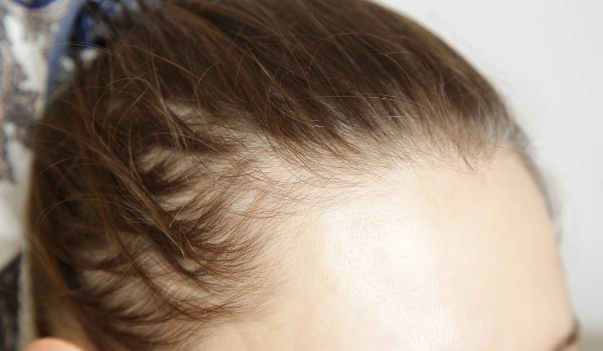 Slăbești, dar îți cade părul? Ce legătură au injecțiile pentru slăbit cu alopecia