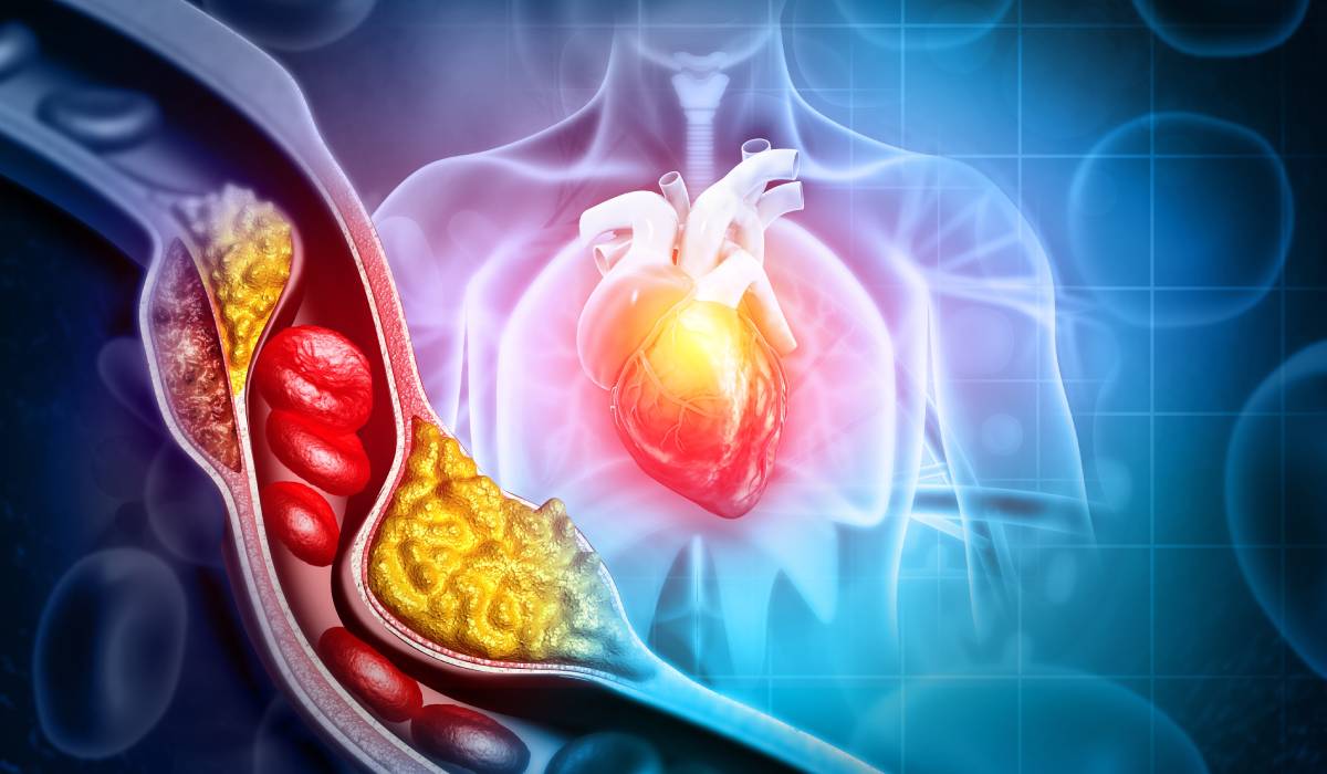 Poți face infarct chiar dacă ai colesterolul normal? Ce spun medicii despre riscul pe care analizele nu îl arată