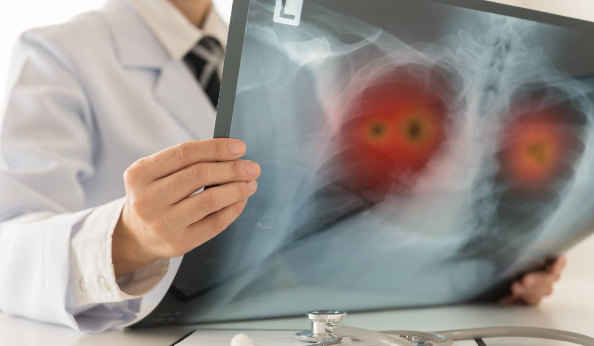 De ce foștii fumători rămân vulnerabili la bolile pulmonare. Ce se întâmplă în plămâni după ce renunți la țigări