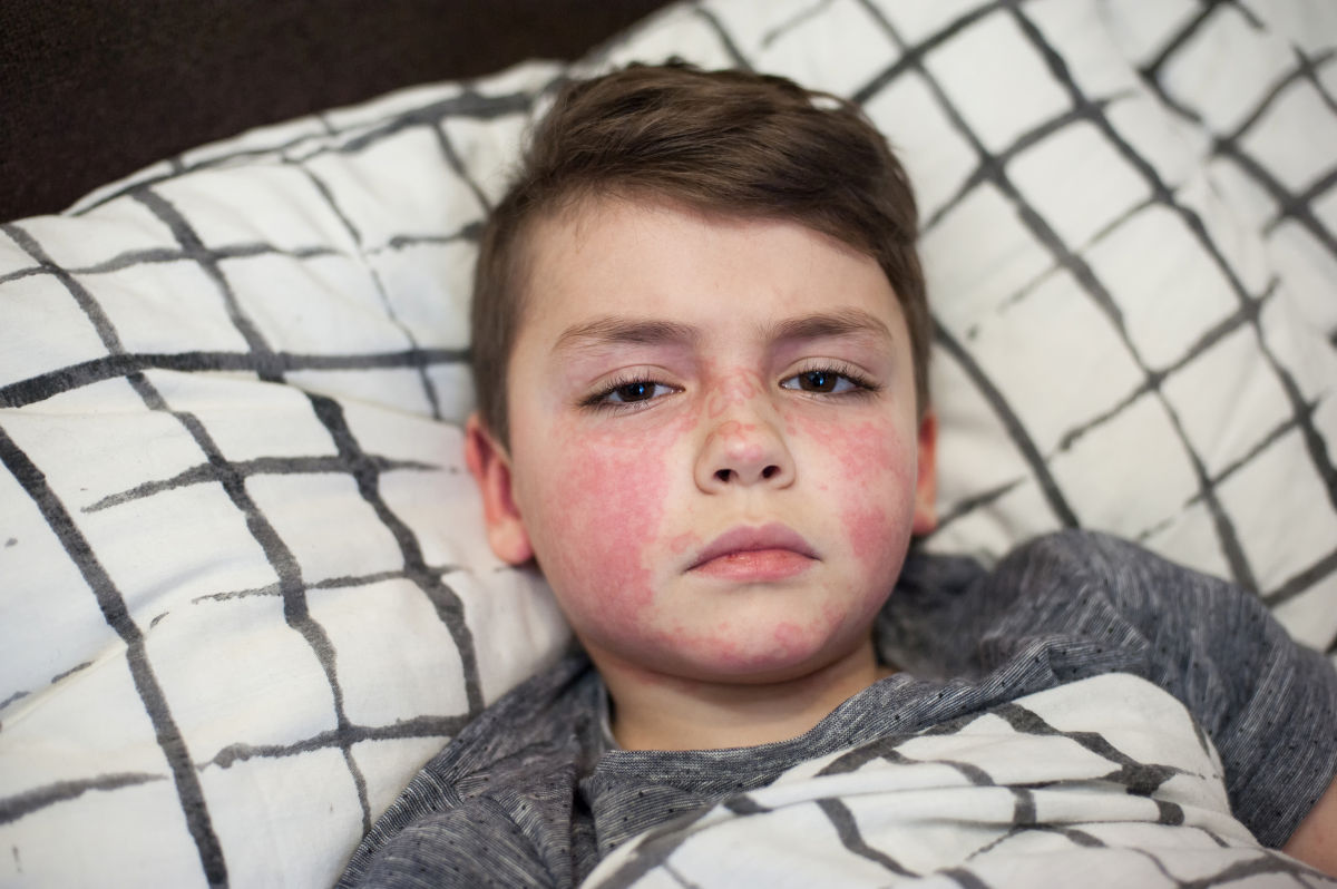 Un elev de 15 ani din Iași, suspect de scarlatină! Ce simptome trebuie să urmărească părinții, potrivit medicilor