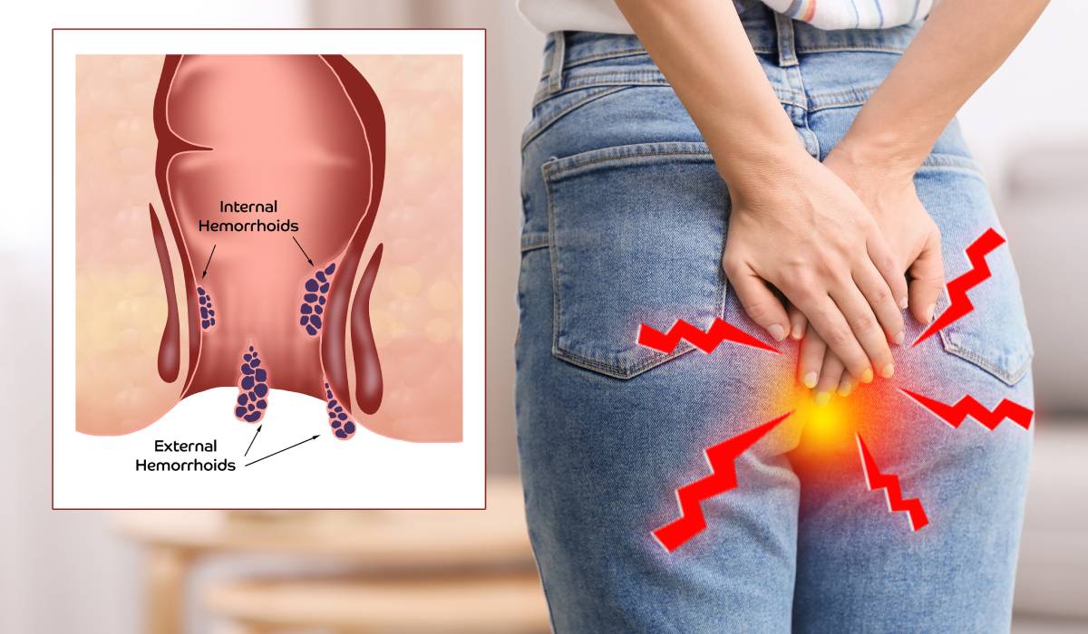 Ce să mănânci pentru a reduce riscul de cancer colorectal. Alimentele recomandate la micul dejun, prânz și cină și ce ar trebui să eviți