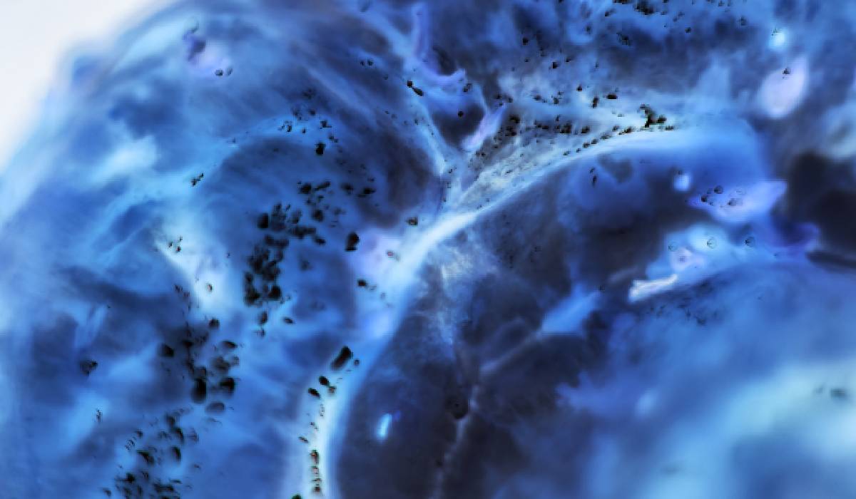 Cancerul pancreatic ar putea fi depistat cu până la 5 ani înainte Cum ar putea ajuta inteligența artificială
