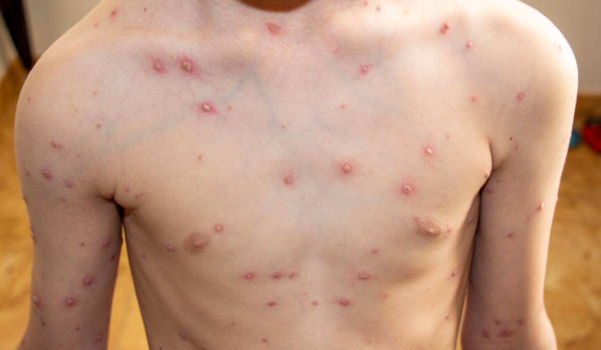 Rujeola, mai aproape de un tratament? Cercetătorii au identificat anticorpi care neutralizează virusul